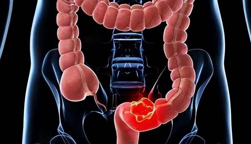 體內有癌「肛門先知」！肛門若「常有5種不適」警惕癌症來臨，醫生：不要錯認為是痔瘡