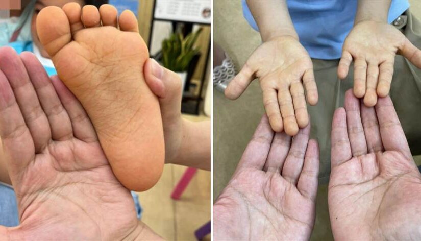 5歲童一覺醒來「手腳詭異蠟黃」！父母嚇瘋急送醫，醫生：別再給孩子吃這個.