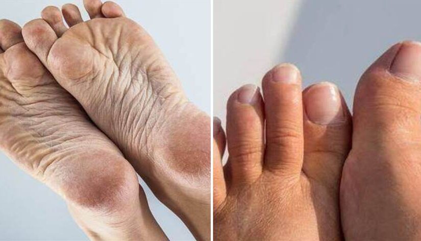 腎衰了，腳先知！腳出現「3種異常」表現，暗示腎臟快要「撐」不住了！