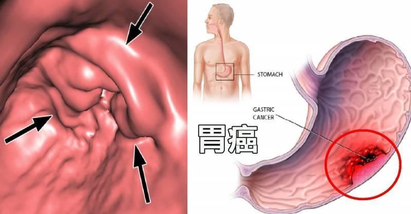 醫生勸告：早晨空腹時，千萬別吃這2種食物，會損傷胃黏膜，並加重原有的胃痛