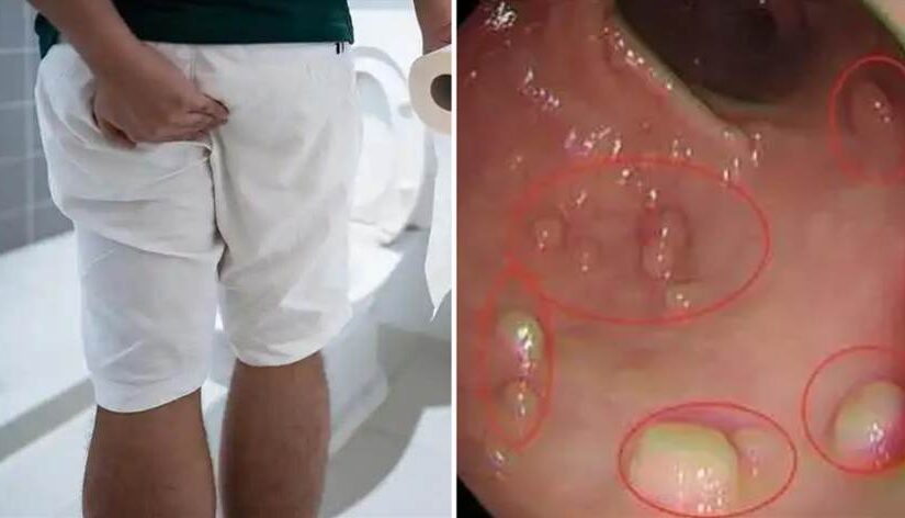 有沒有大腸瘜肉「上廁所就知道」！醫生警告：身體最早「4大前兆」別拖成癌…
