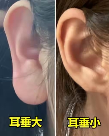俗語說：耳垂大就「大富大貴」，耳垂小就「福薄運少」錯了