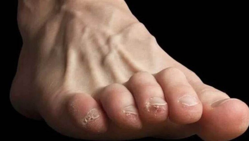 醫生：腳上出現這3種情況「暗示你血糖」已經很高了…趕緊去醫院！