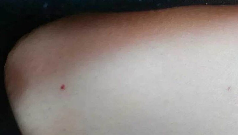 身上的「紅點」怎麼越長越多，是肝臟出問題了？告訴你紅點是什麼…