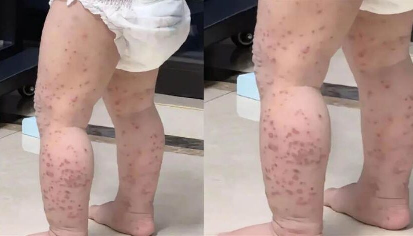 婆婆照顧2歲寶寶不到半天，竟全身「起滿紅疹…」緊急送醫！醫生怒斥：老人「這個習慣」一定要改掉！