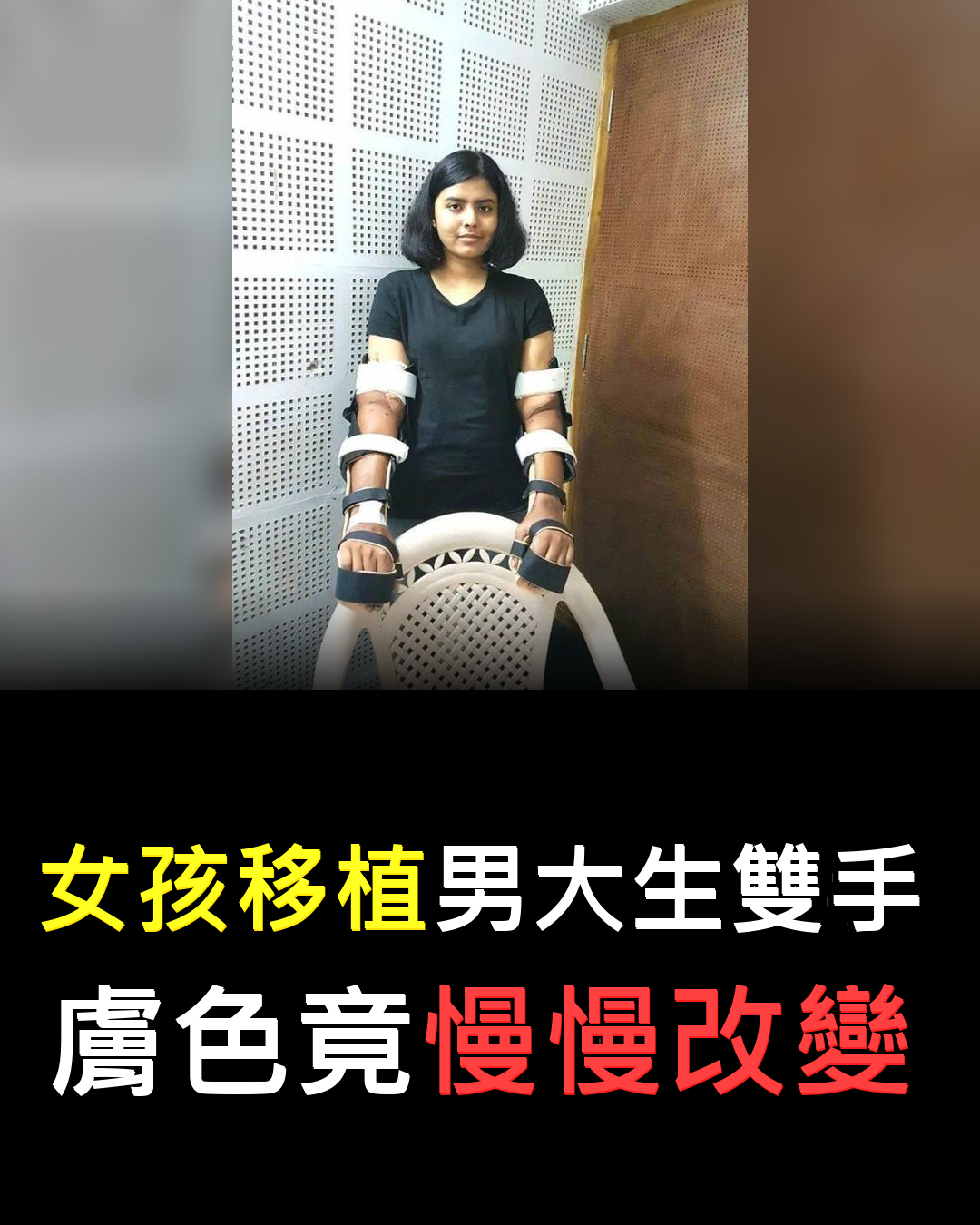 斷臂女孩重獲雙手?身體變化震驚醫界????????