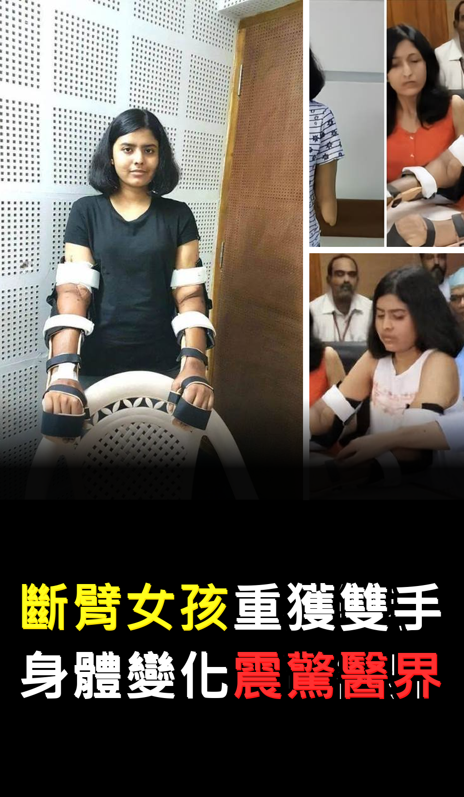 斷臂女孩重獲雙手?身體變化震驚醫界????????