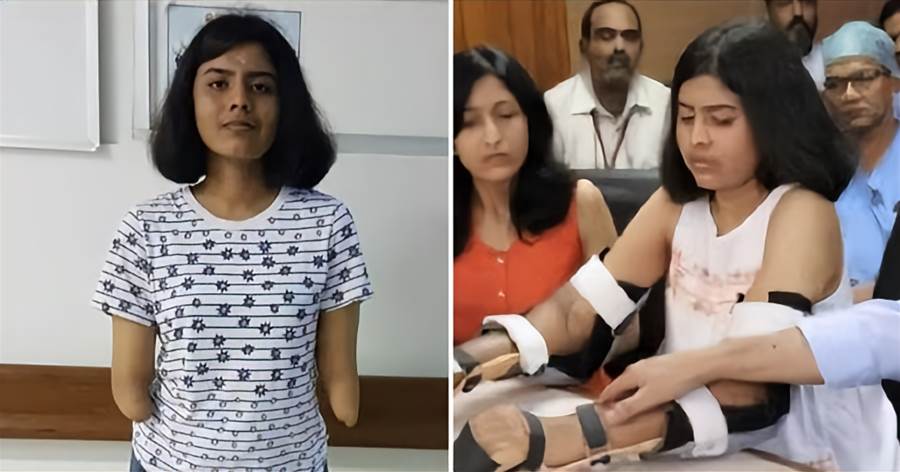 斷臂女孩重獲雙手?身體變化震驚醫界????????