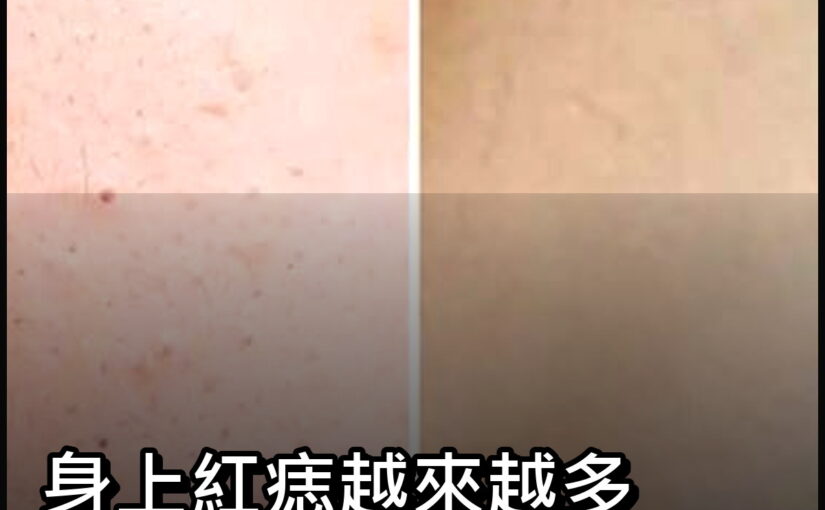 身上紅痣越來越多別輕忽，醫師提醒，這幾種情況最好留意