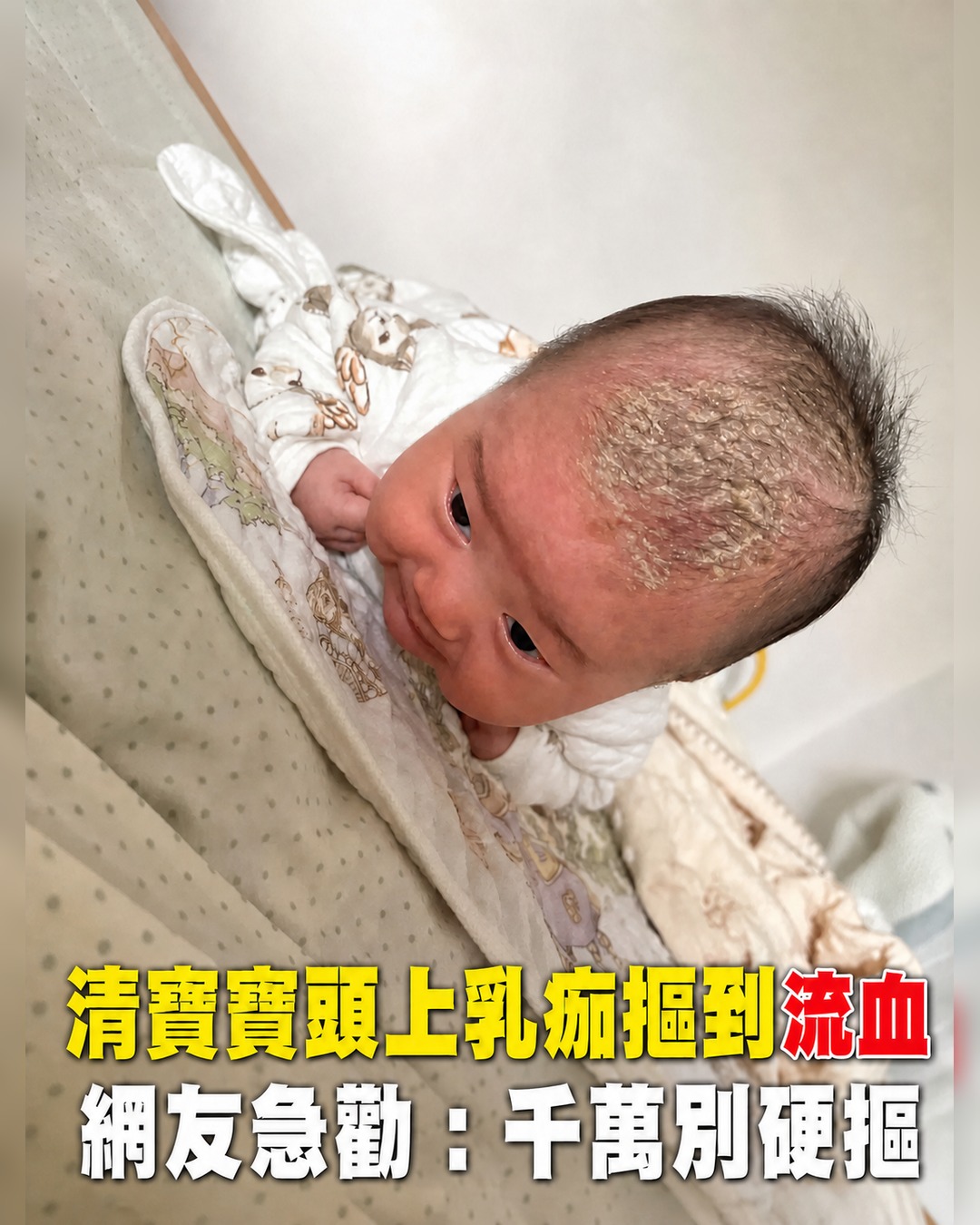 新手媽媽崩潰!為清寶寶頭上「舅舅屎」摳到流血…網友急提醒後教1招