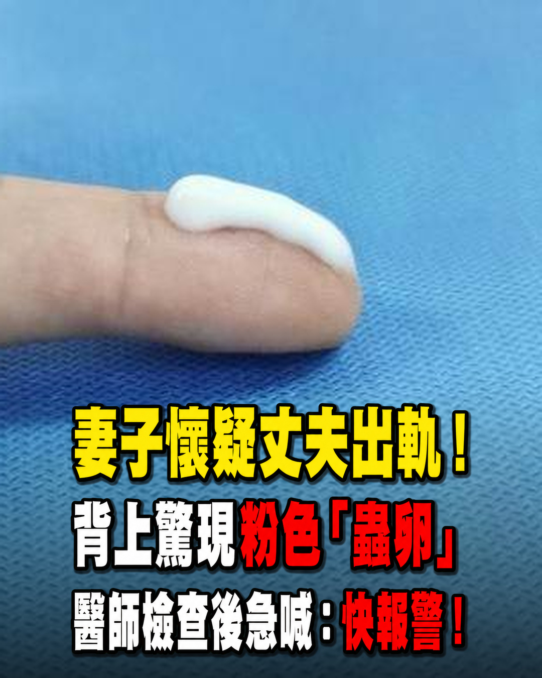 妻子懷疑丈夫出軌!發現丈夫身上驚現粉色「蟲卵」醫生檢查後大驚:這不是蟲卵,快報警!