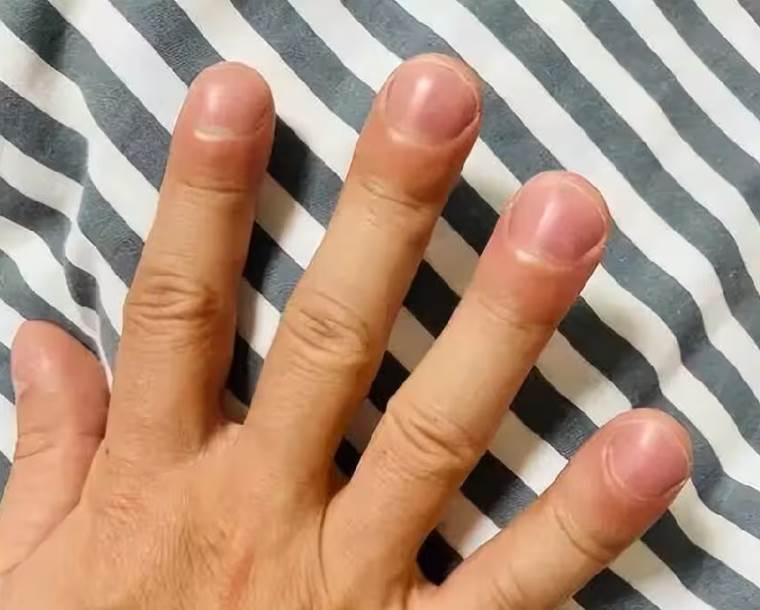 醫生直言:肺癌早期不是咳嗽,是身上出現「3大異常」,千萬別忽視