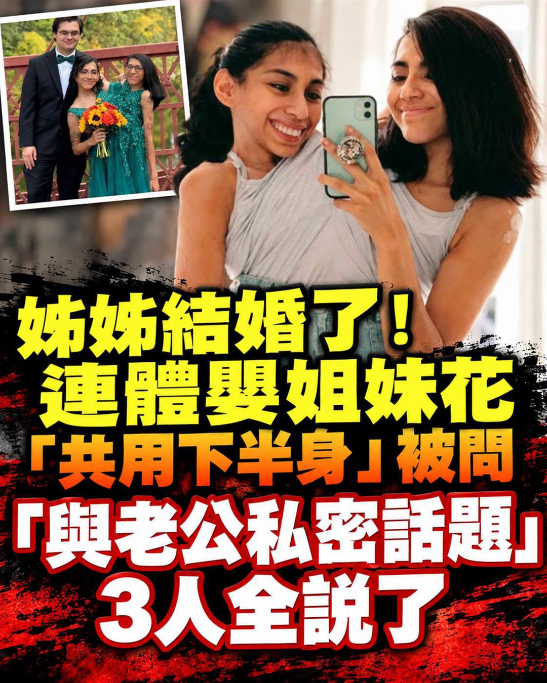 醫師曾估活不過3天，連體姊妹姊姊結婚後3人怎麼面對私密問題？
