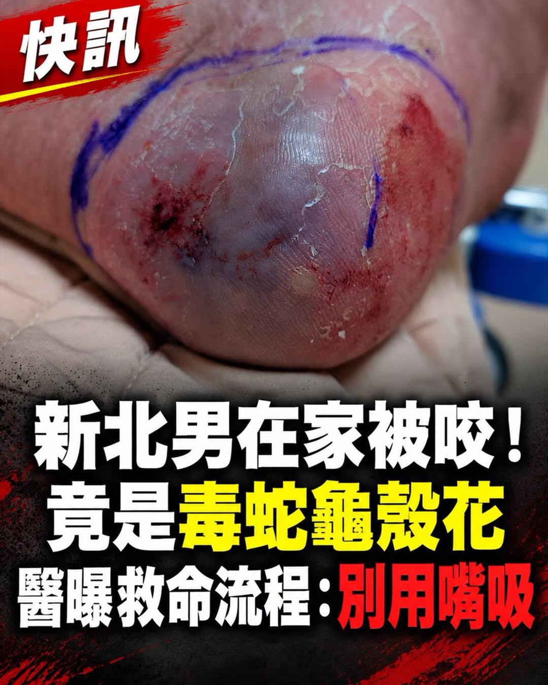 龜殼花咬傷示意圖