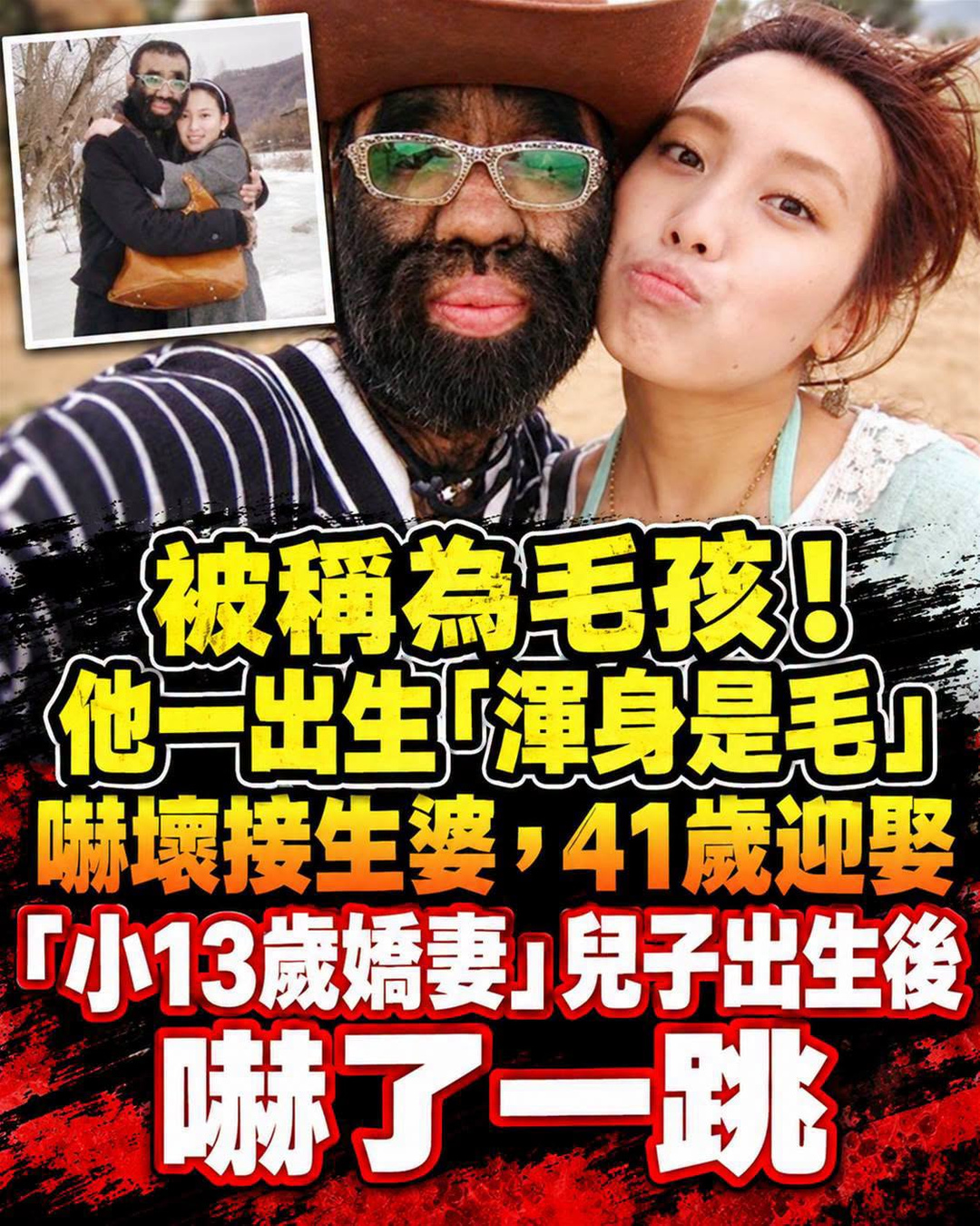 被稱為「毛孩」!他一出生「渾身是毛」嚇壞接生婆,41歲迎娶「小13歲嬌妻」兒子出生後,嚇了一跳