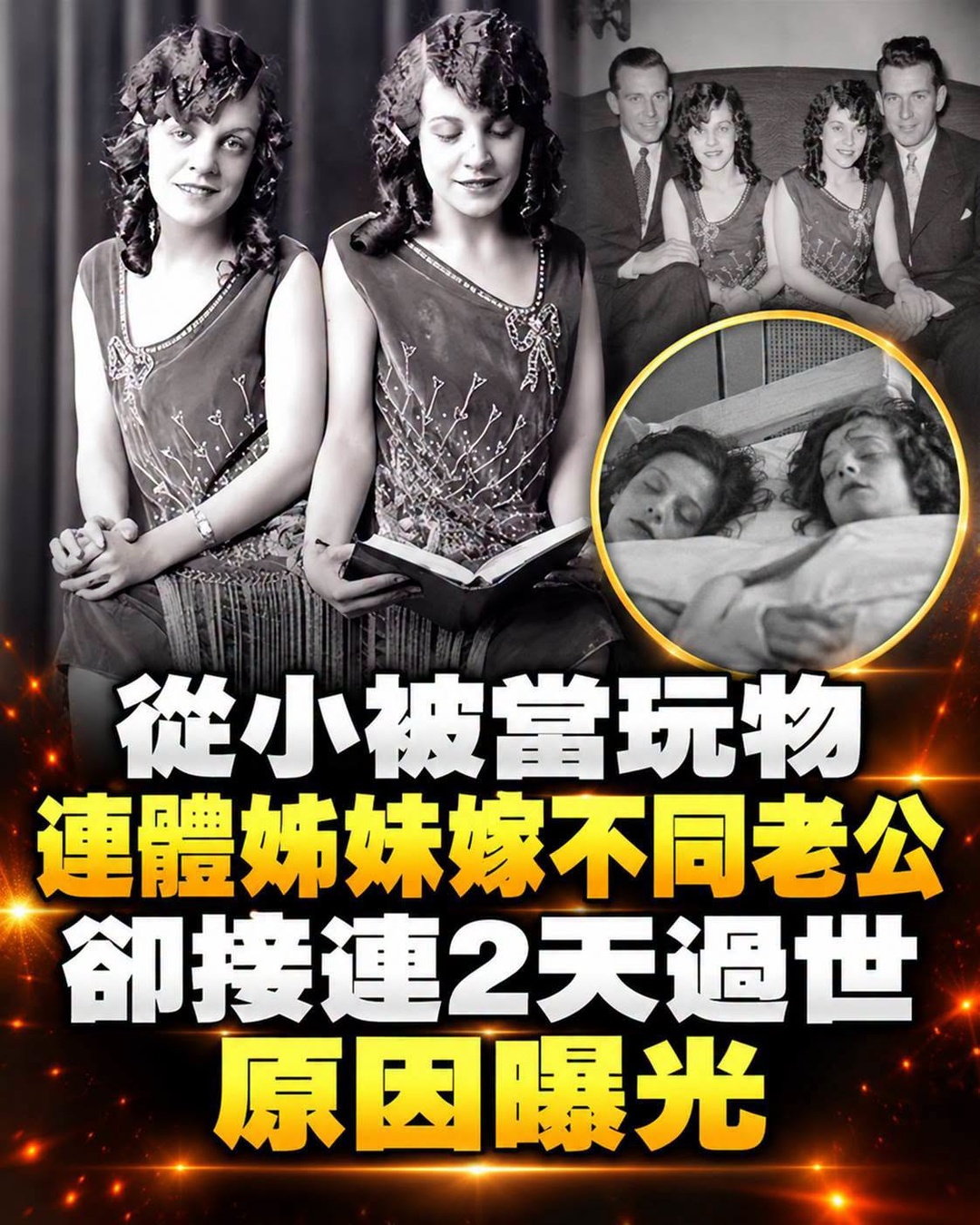 活到60歲的連體姊妹「嫁不同老公」,從被當玩物到爭取自由,結局藏著一段遺憾
