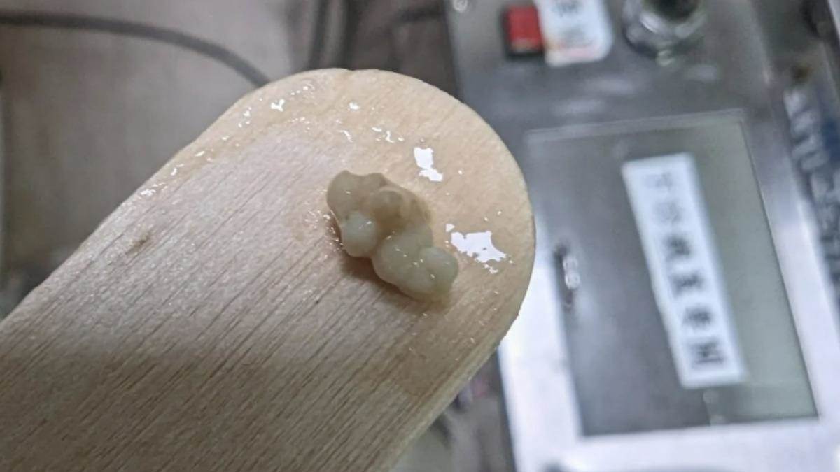 扁桃腺結石示意圖