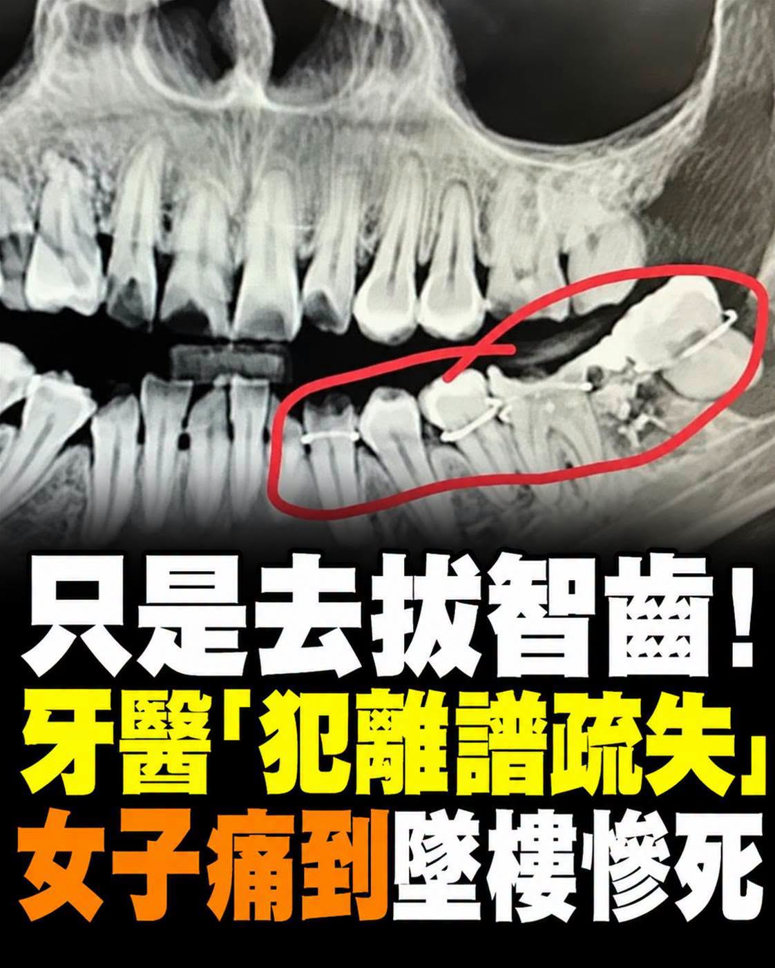34歲女子拔智齒後連續5天無法進食,最後一則貼文竟成永別
