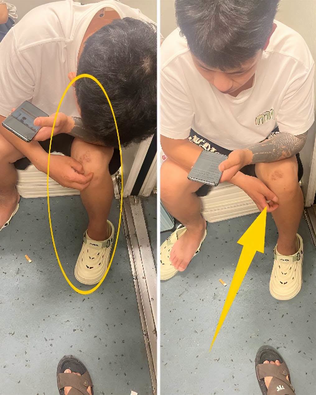 紋身男膝蓋冒出異常肉芽，車廂內頻頻抓癢，後續真相讓人不敢只靠肉眼判斷