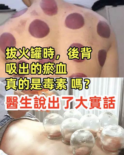拔火罐後背一片紫,真的是把毒素吸出來?真正原因很多人都搞錯