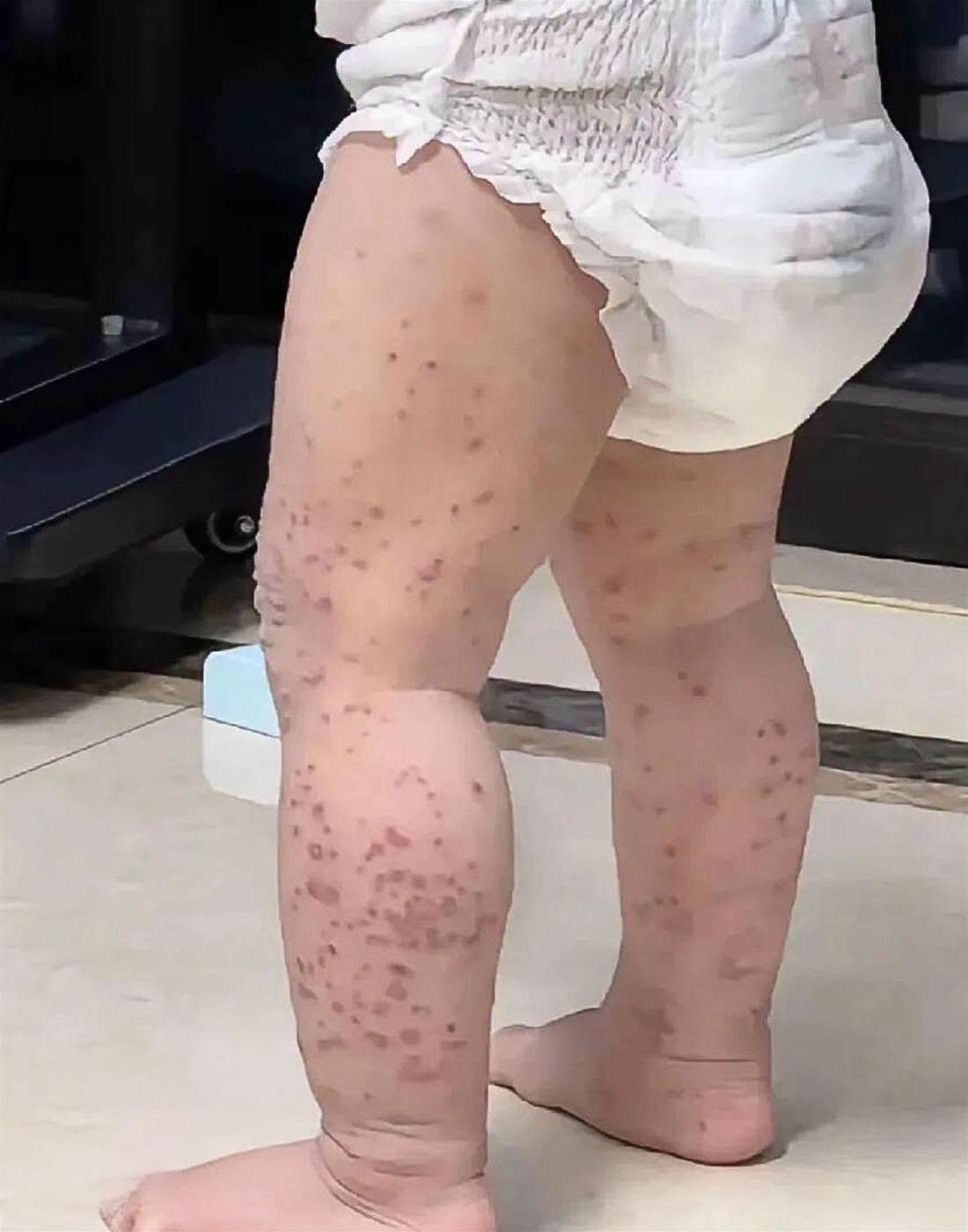 婆婆照顧2歲寶寶不到半天，竟全身「起滿紅疹」緊急送醫！醫生怒斥，「這個習慣」一定要改掉